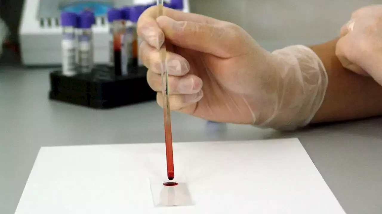 Un análisis de sangre puede detectar de forma precoz algunos tipos de leucemia