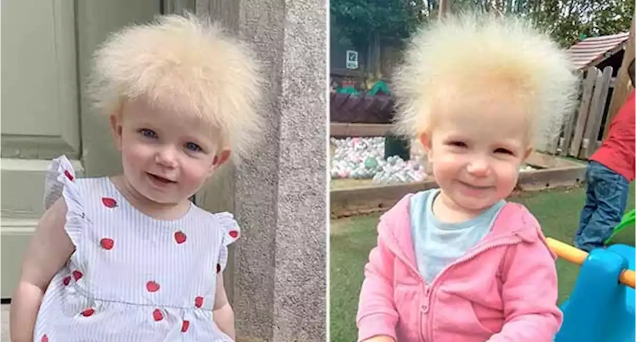 Toddler's 'awesome' hair diagnosed as 'uncombable hair syndrome'